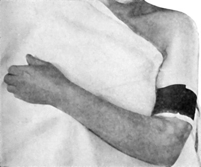 Fig. 6.&mdash;Passive Hyper&aelig;mia of Hand and Forearm induced by Bier's Bandage.