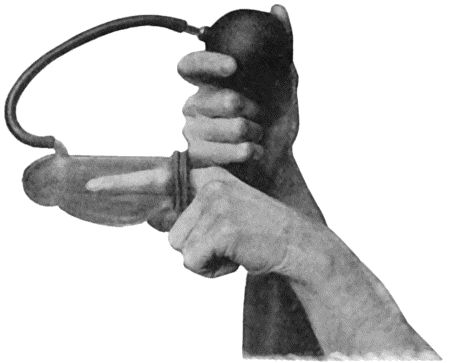 Fig. 7.&mdash;Passive Hyper&aelig;mia of Finger induced by Klapp's Suction Bell.