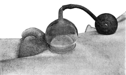 Fig. 8.&mdash;Passive Hyper&aelig;mia induced by Klapp's Suction Bell for Inflammation of Inguinal Gland.
