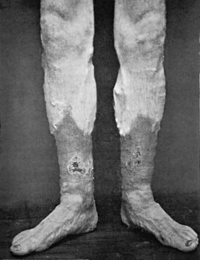Fig. 14.&mdash;Leg Ulcers associated with Varicose Veins and Pigmentation of the Skin.