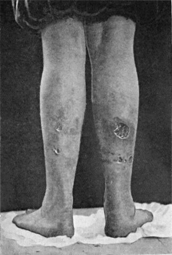 Fig. 16.&mdash;Bazin's Disease in a girl &aelig;t.&nbsp;16.