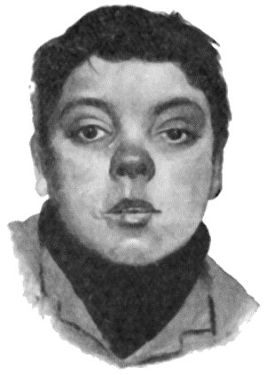 Fig. 43.&mdash;Facies of Inherited Syphilis.  (From Dr. Byrom Bramwell's Atlas of Clinical Medicine.)