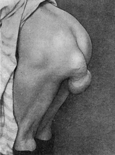 Fig. 46.&mdash;Pedunculated Lipoma of Buttock of forty years' duration in a woman &aelig;t.&nbsp;68.