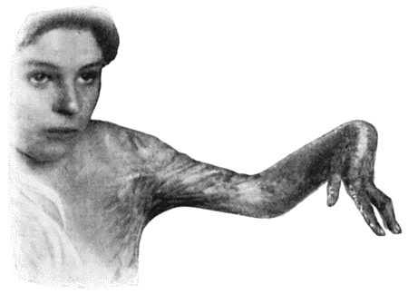 Fig. 63.&mdash;Cicatricial Contraction following Severe Burn.