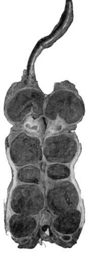 Fig. 66.&mdash;Thrombosis in Tortuous and Pouched Great Saphena Vein, in longitudinal section.
