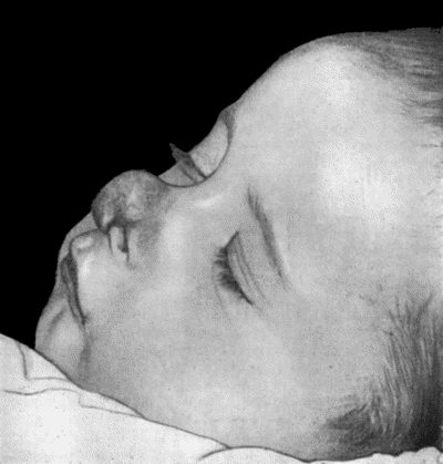 Fig. 68.&mdash;Mixed N&aelig;vus of Nose which was subsequently cured by Electrolysis.