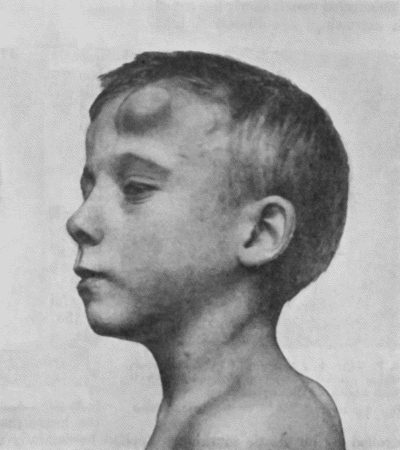Fig. 69.&mdash;Cirsoid Aneurysm of Forehead in a boy &aelig;t.&nbsp;10. (Mr. J.W. Dowden's case.)