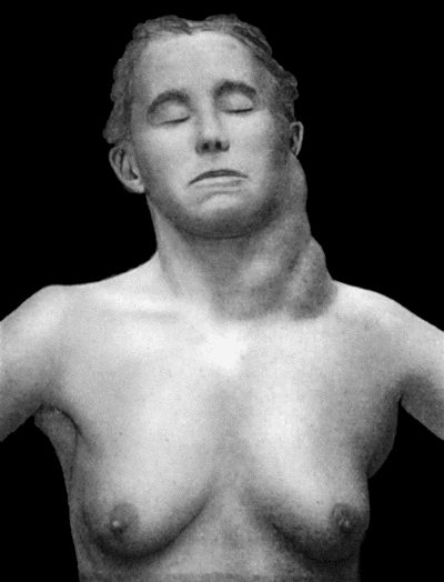 Fig. 81.&mdash;Lymphadenoma (Hodgkin's Disease) affecting left side of neck and left axilla, in a woman &aelig;t.&nbsp;44. Three years' duration.