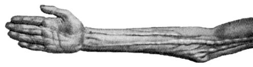 Fig. 86.&mdash;Diffuse enlargement of Nerves in generalised Neuro-fibromatosis. (After R.W. Smith.)
