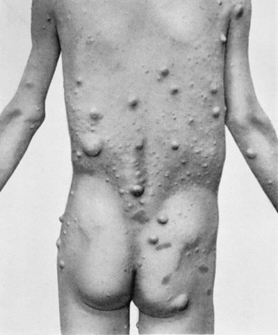 Fig. 88.&mdash;Multiple Neuro-fibromas of Skin (Molluscum fibrosum, or Recklinghausen's disease).