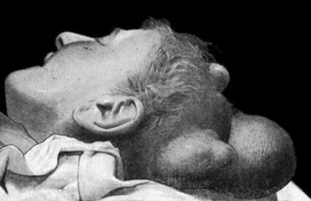 Fig. 99.&mdash;Multiple Sebaceous Cysts or Wens; the larger ones are of many years' duration.