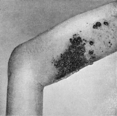 Fig. 104.&mdash;Diffuse Melanotic Cancer of Lymphatics of Skin secondary to a Growth in the Sole of the Foot.