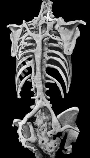 Fig. 112.&mdash;Ossification in Muscles of Trunk in a case of generalised Ossifying Myositis. (Photograph lent by Dr. Rustomjee.)