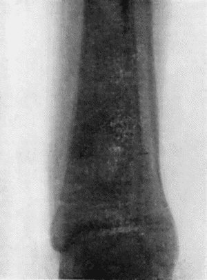 Fig. 121.&mdash;Radiogram of Brodie's Abscess in Lower End of Tibia.