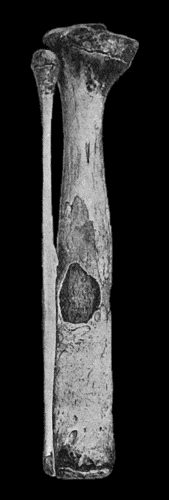 Fig. 125.&mdash;Tuberculous Disease of Child's Tibia, showing sequestrum in medullary cavity, and increase in girth from excess of new bone.
