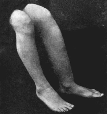 Fig. 132.&mdash;Sabre-blade Deformity of Left Tibia in Inherited Syphilis.  (From a photograph lent by Sir George T. Beatson.)