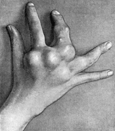 Fig. 142.&mdash;Multiple Chondromas of Phalanges and Metacarpals in a boy &aelig;t.&nbsp;10 (cf. Fig. 143).