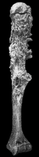 Fig. 147.&mdash;Periosteal Sarcoma of Humerus, after maceration. (Anatomical Museum, University of Edinburgh.)
