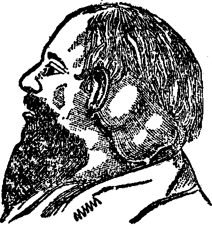 Illustration:
Fig. 1. A Scrofulous Tumor