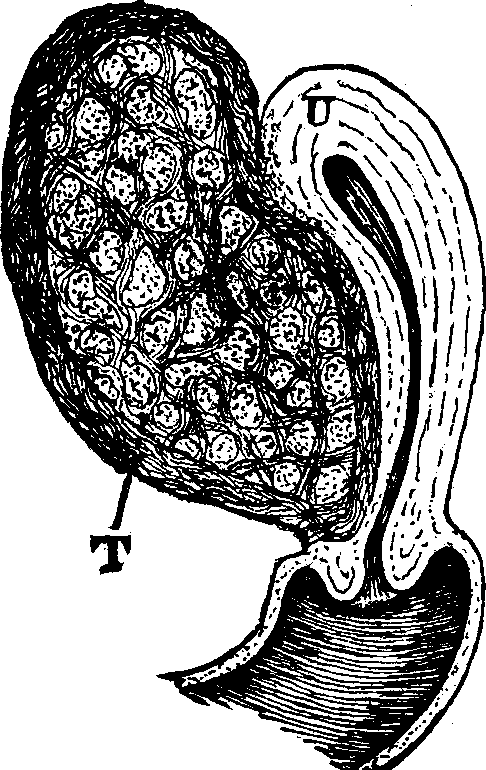 Illustration:
Fig. 20. U, Uterus. T, Tumor.