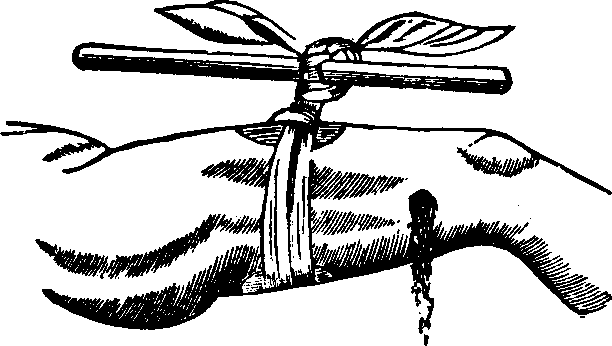 Illustration:
Fig. 1. The field Tourniquet as applied. 