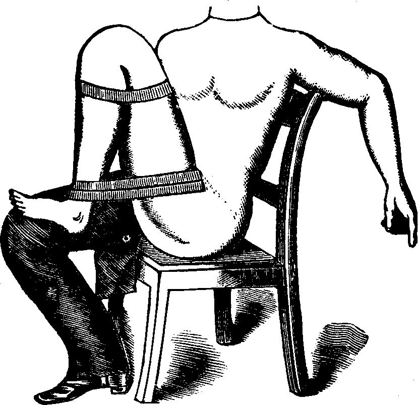 Illustration:
Fig. 3. Mode of employing flexion for the arrest of hemorrhage from a wound
below the knee.