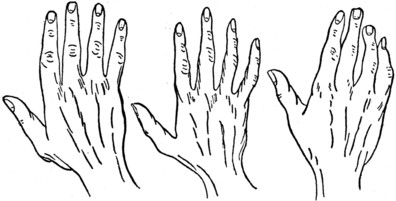 Plate II.&mdash; Part II. Fig. 1.&mdash;THE CONIC OR ARTISTIC HAND. Fig. 2.&mdash;THE PSYCHIC OR IDEALISTIC HAND. Fig. 3.&mdash;THE MIXED HAND.